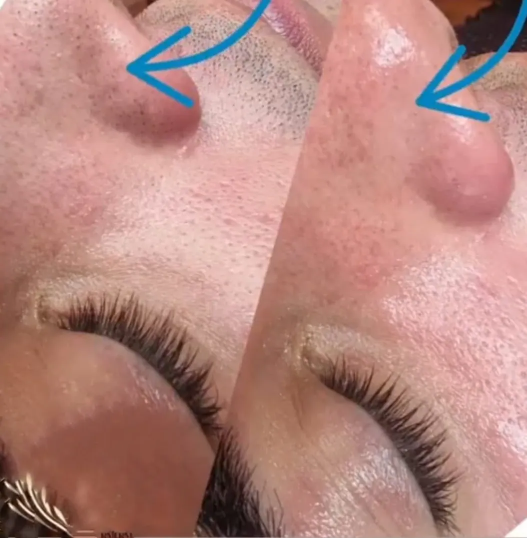Vorher-Nachher Microdermabrasion