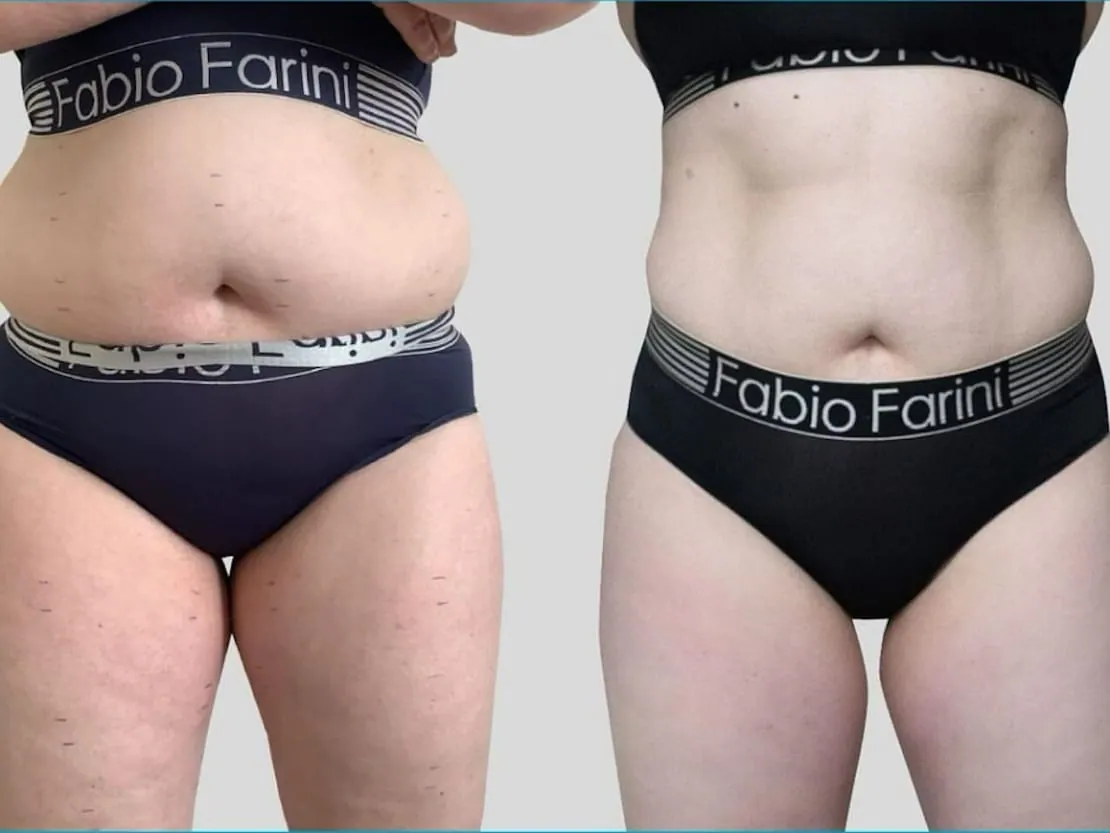 Vorher-Nachher DiViNiA Bauch